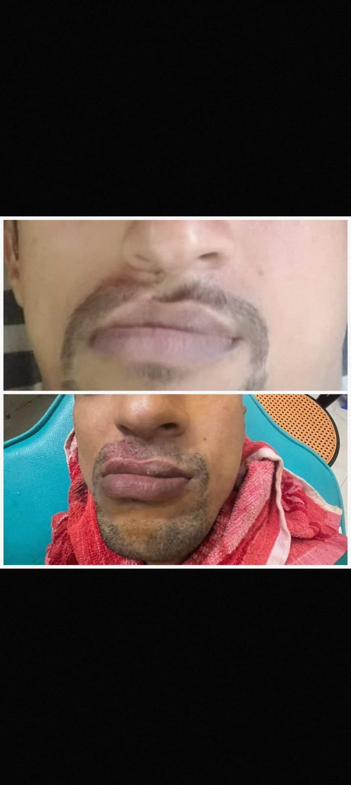 mustache transplant
